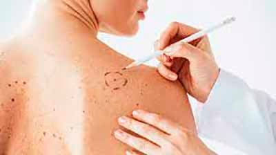 Cómo proteger la piel en verano con tratamiento oncológico