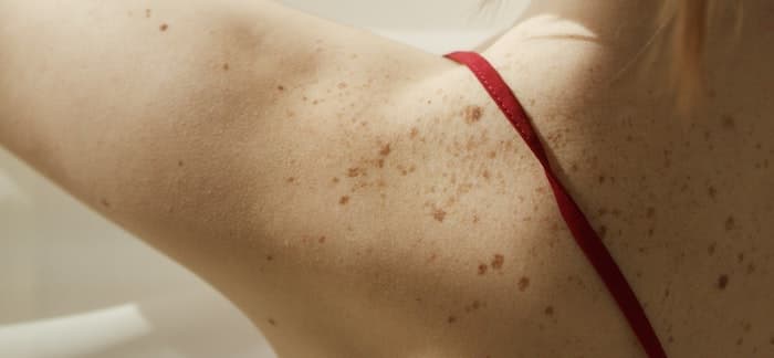 Melanoma